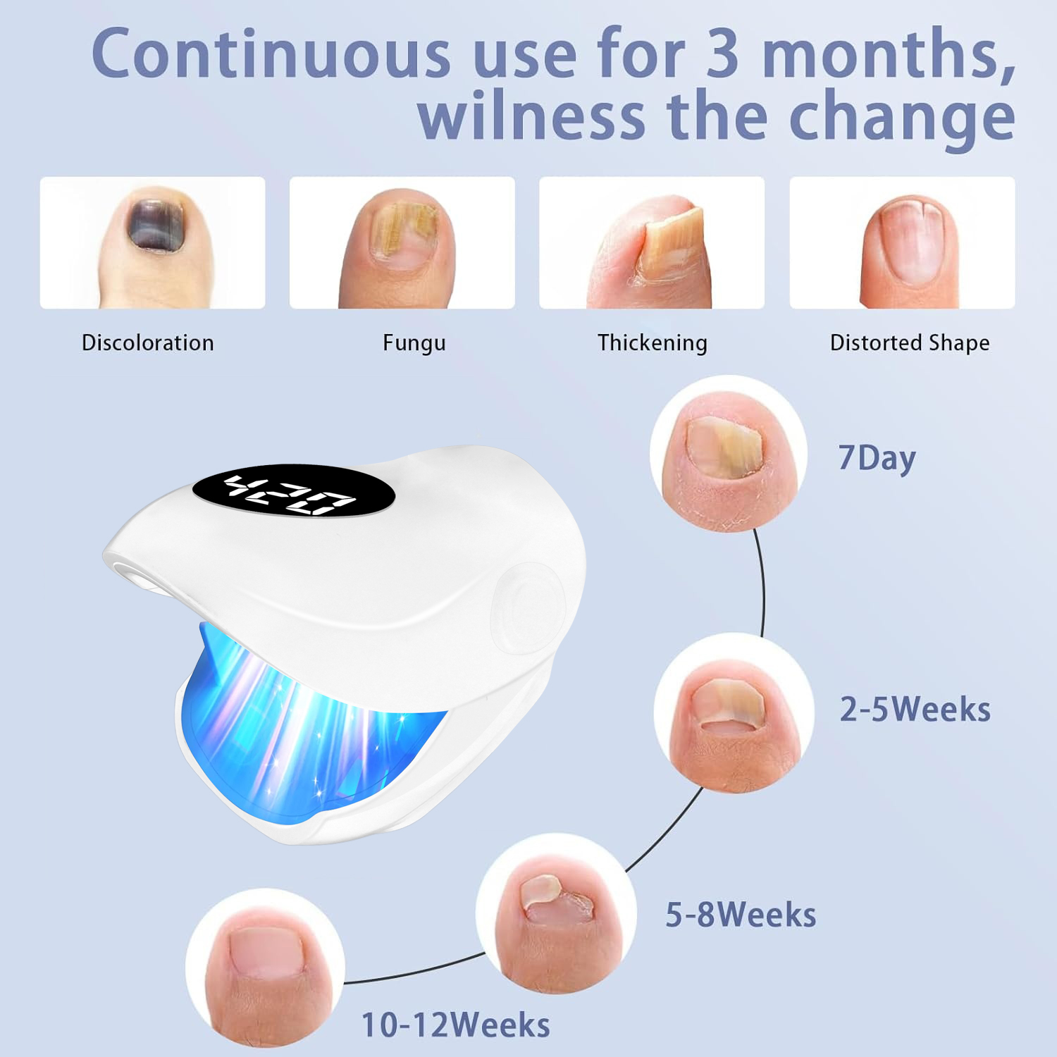 جهاز علاج فعال للفطريات على ال - مراجعة Industrial Laser Removal وسعره